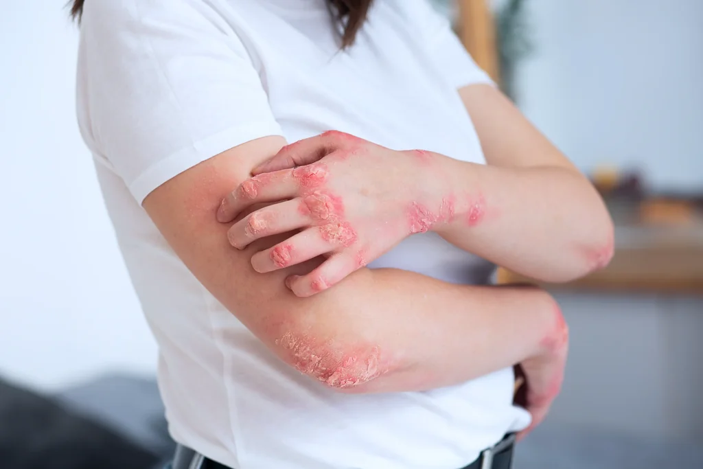 Eczema at AgeRejuvenation in Tampa, FL