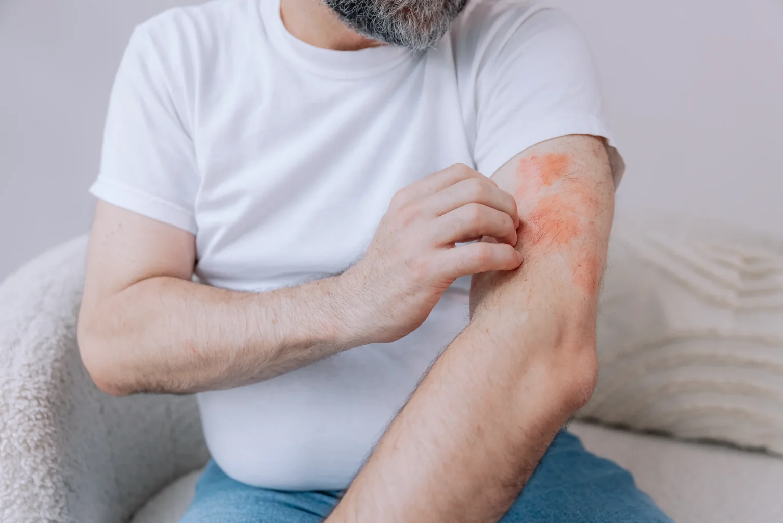 Eczema at AgeRejuvenation in Tampa, FL