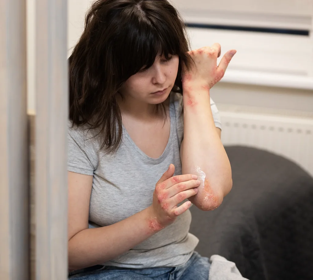 Psoriasis at AgeRejuvenation in Tampa, FL