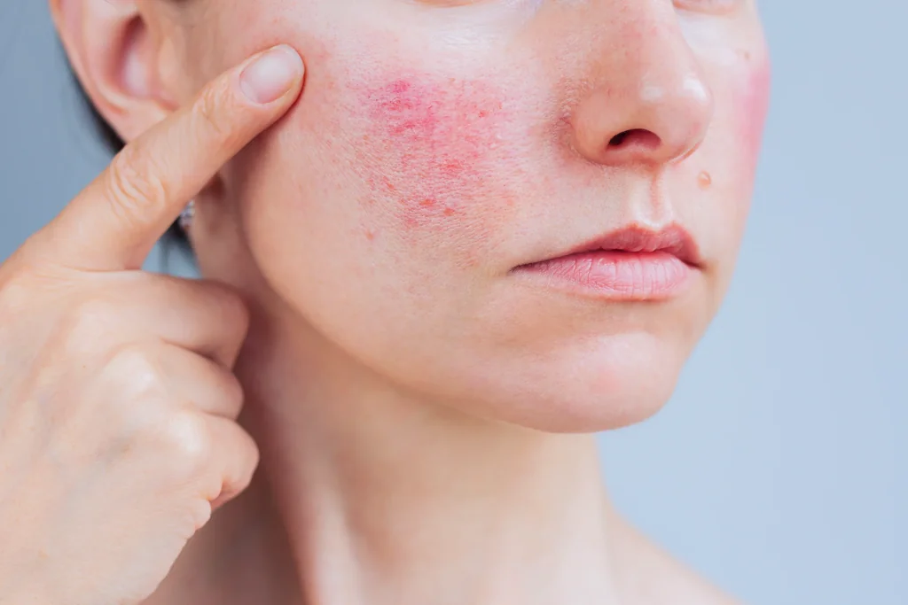 Rosacea at AgeRejuvenation in Tampa, FL